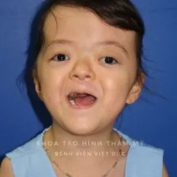 Điều trị thành công hội chứng hẹp hộp sọ phức tạp (Apert’s Syndrome) hiếm có trên thế giới - Bệnh viện Việt Đức