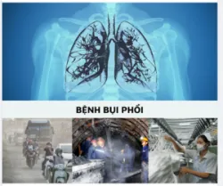 BỆNH BỤI PHỔI ĐANG BÀO MÒN SỨC KHỎE CỦA BẠN NHƯ THẾ NÀO?