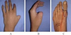 Phẫu thuật chuyển ngón chân tái tạo ngón tay cái - Bệnh viện 108