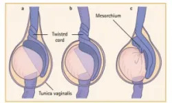 Nguyên nhân Xoắn tinh hoàn - Bệnh viện Việt Đức