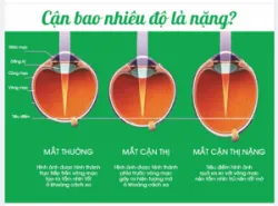 Cận thị bao nhiêu độ là nặng​​​​​​​ Cận thị nặng thì sao