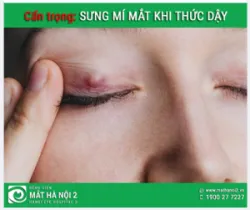 CẨN TRỌNG: Sưng mí mắt khi thức dậy dấu hiệu bạn đang mắc phải chứng bệnh nguy hiểm