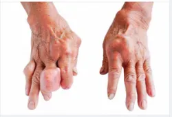 CẢNH BÁO 5 BIẾN CHỨNG NGUY HIỂM CỦA BỆNH GOUT