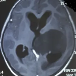 Cảnh báo: Trẻ suýt mất mạng vì được “chữa” u não bằng “keto” - Bệnh viện Việt Đức