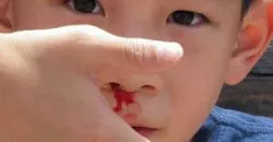 Chảy máu cam ở trẻ em và cách xử trí - Bệnh viện nhi Trung Ương