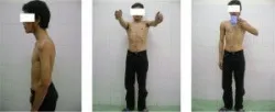 Điều trị di chứng liệt dây thần kinh ở chi trên bằng phẫu thuật chuyển gân - Bệnh viện 108