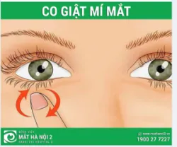 CO GIẬT MÍ MẮT: không phải điềm báo tâm linh
