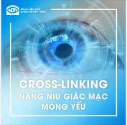 CROSS-LINKING: BẢO VỆ GIÁC MẠC TOÀN DIỆN