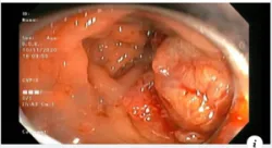 ĐẠI TIỆN RA MÁU TRIỆU CHỨNG NGUY HIỂM CỦA UNG THƯ TRỰC TRÀNG