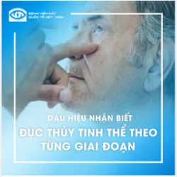 DẤU HIỆU NHẬN BIẾT ĐỤC THỦY TINH THỂ THEO TỪNG GIAI ĐOẠN