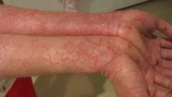 Các dạng viêm da dị ứng -bệnh viện nhi Trung Ương