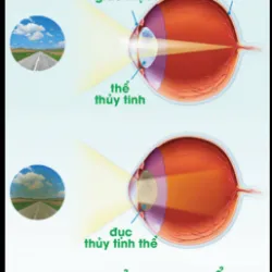 Đục thủy tinh thể ảnh hưởng đến cuộc sống như thế nào