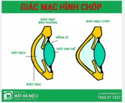 GIÁC MẠC HÌNH CHÓP