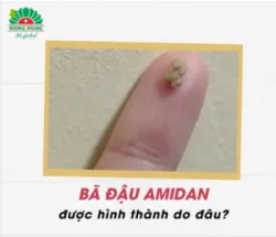 "GIẢI MÃ" NGUYÊN NHÂN HÌNH THÀNH BÃ ĐẬU AMIDAN BÃ ĐẬU AMIDAN là các khối hạt nhỏ màu vàng hoặc trắng bột như bã đậu.