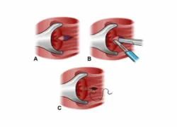 Bệnh nứt kẽ hậu môn -Bệnh Viện Việt Đức