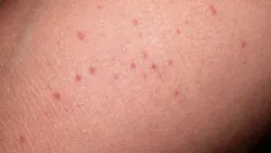 Chăm sóc trẻ bị sốt xuất huyết tại nhà - Bệnh viện nhi Trung Ương