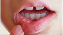 Chăm sóc và dự phòng viêm niêm mạc miệng do điều trị hóa chất ở trẻ em - Bệnh viện nhi Trung Ương