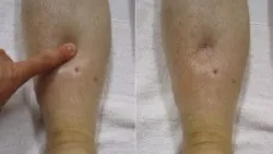 Những điều cần biết về Hội chứng thận hư ở trẻ em - Bệnh viện nhi Trung Ương
