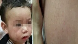 Bệnh sởi ở trẻ em: Phát hiện các dấu hiệu sớm và Cách chăm sóc tại nhà  - Bệnh viện nhi Trung Ương