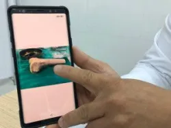 Ghép xương từ người hiến chết não cứu chân bệnh nhân bị u tế bào khổng lồ - Bệnh viện Việt Đức