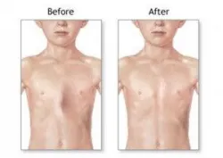 Cách phát hiện và điều trị bệnh lý dị dạng lồng ngực bẩm sinh - Bệnh viện Việt Đức