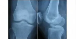 Cách nhận biết bệnh đứt dây chằng chéo trước khớp gối - Bệnh viện Việt Đức
