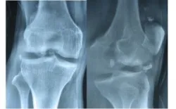 Phẫu thuật nội soi lấy bỏ dị vật khớp gối - Bệnh viện Việt Đức