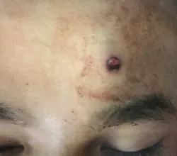 Đi săn đêm bằng súng tự chế, nam thanh niên 16 tuổi bị đạn bắn xuyên não - Bệnh viện Việt Đức