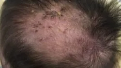 Cảnh giác với hội chứng mô bào khi trẻ chốc đầu dai dẳng - Bệnh viện nhi Trung Ương