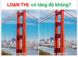 Loạn thị có tăng độ như các tật khúc xạ không?