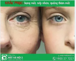 Lưu ý chọn kem mắt khắc phục bọng mắt, nếp nhăn, quầng thâm