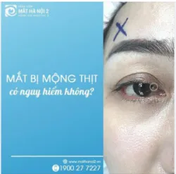 Mắt bị mộng thịt có nguy hiểm không