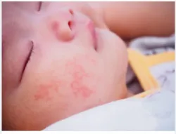 NHẬN BIẾT VÀ XỬ TRÍ KHI TRẺ BỊ DỊ ỨNG ĐẠM BÒ