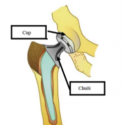 Tập luyện và những lưu ý đối với người bệnh sau mổ thay khớp háng - Bệnh viện Việt Đức
