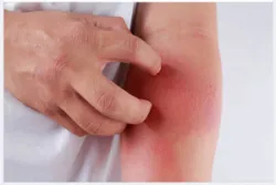 PHÒNG NGỪA DỊ ỨNG THỜI TIẾT KHI TRỜI CHUYỂN LẠNH