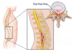 Bệnh lý Hẹp ống sống - Bệnh viện Việt Đức