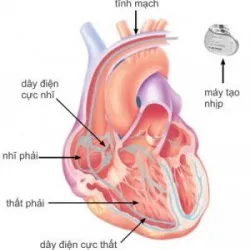 Sống chung với máy tạo nhịp tim – những điều cần biết - Bệnh viện Việt Đức