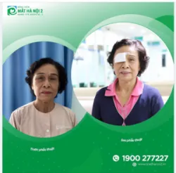 Quá trình "mổ mắt" Phaco xuất viện TRONG NGÀY