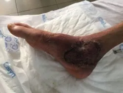 Nam bệnh nhân suýt mất chân do tự điều trị thuốc nam tại nhà - Bệnh viện Việt Đức