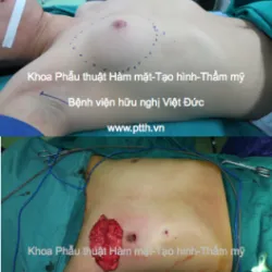Lần đầu tiên ứng dụng kỹ thuật nội soi qua đường nách cắt bỏ toàn bộ tuyến vú trên bệnh nhân bị hội chứng vú to nam giới - Bệnh viện Việt Đức