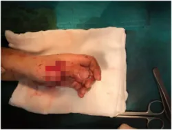 Trồng lại ngón cái đứt rời của cháu bé 6 tuổi bị bê tông rơi vào tay - Bệnh viện Việt Đức