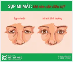 SỤP MI MẮT KHI NÀO CẦN ĐIỀU TRỊ