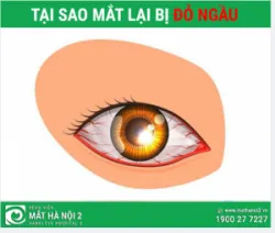 Tại sao mắt lại bị đỏ ngầu? 