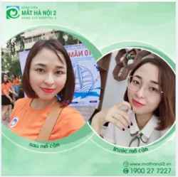 THAY ĐỔI TUYỆT VỜI SAU KHI MỔ CẬN THOẢI MÁI THAM GIA KỶ NIỆM 10 NĂM TỐT NGHIỆP