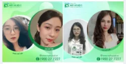 THAY ĐỔI TUYỆT VỜI SAU KHI MỔ CẬN