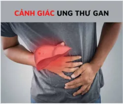 UNG THƯ GAN  "SÁT THỦ THẦM LẶNG" KHÔNG TRỪ MỘT AI