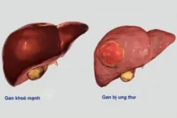 Ung thư “sát thủ” với nam giới bắt nguồn từ bệnh lý mãn tính - Bệnh viện Việt Đức