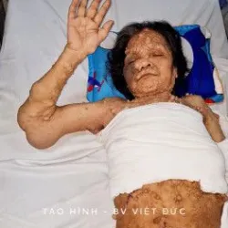 Giải cứu người phụ nữ hơn 40 năm mang khối u khổng lồ vùng nách: Phẫu thuật giải phóng cánh đại bàng - Bệnh viện Việt Đức