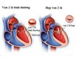 Bệnh lý Hẹp van hai lá - Bệnh viện Việt Đức