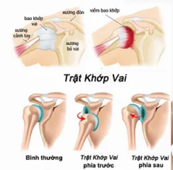 Trật khớp vai – Chấn thương không thể coi thường - Bệnh viện Việt Đức